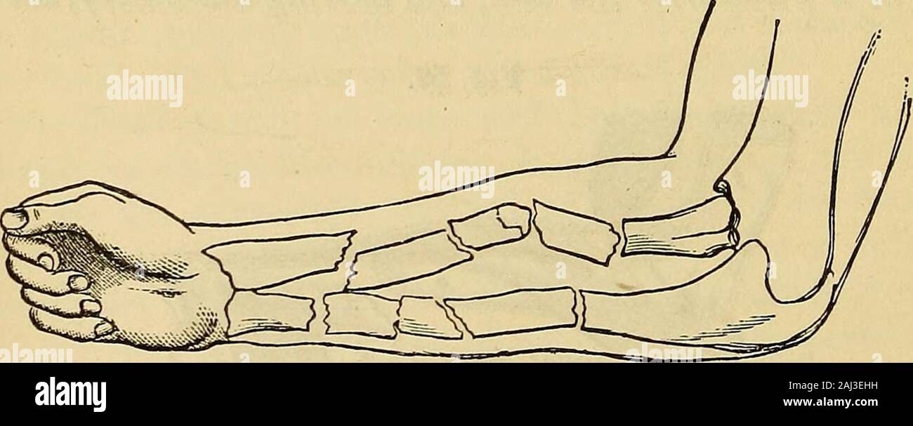 A practical and systematic treatise on fractures and dislocations . aken. The displacement of the frag-ments may not be observable in some instances, for the brokenends do not always become disengaged, but in most cases thedeformity is so great as to indicate at once the nature of theinjury. When there is overlapping of the fragments theremust, of necessity, be shortening of the arm. The peculiardistortion produced by bending the limb near the seat of frac-ture, can not be misapprehended. Crepitus can be elicited bygrasping the arm above and below the fracture, and rotatingthe limb while it is Stock Photo