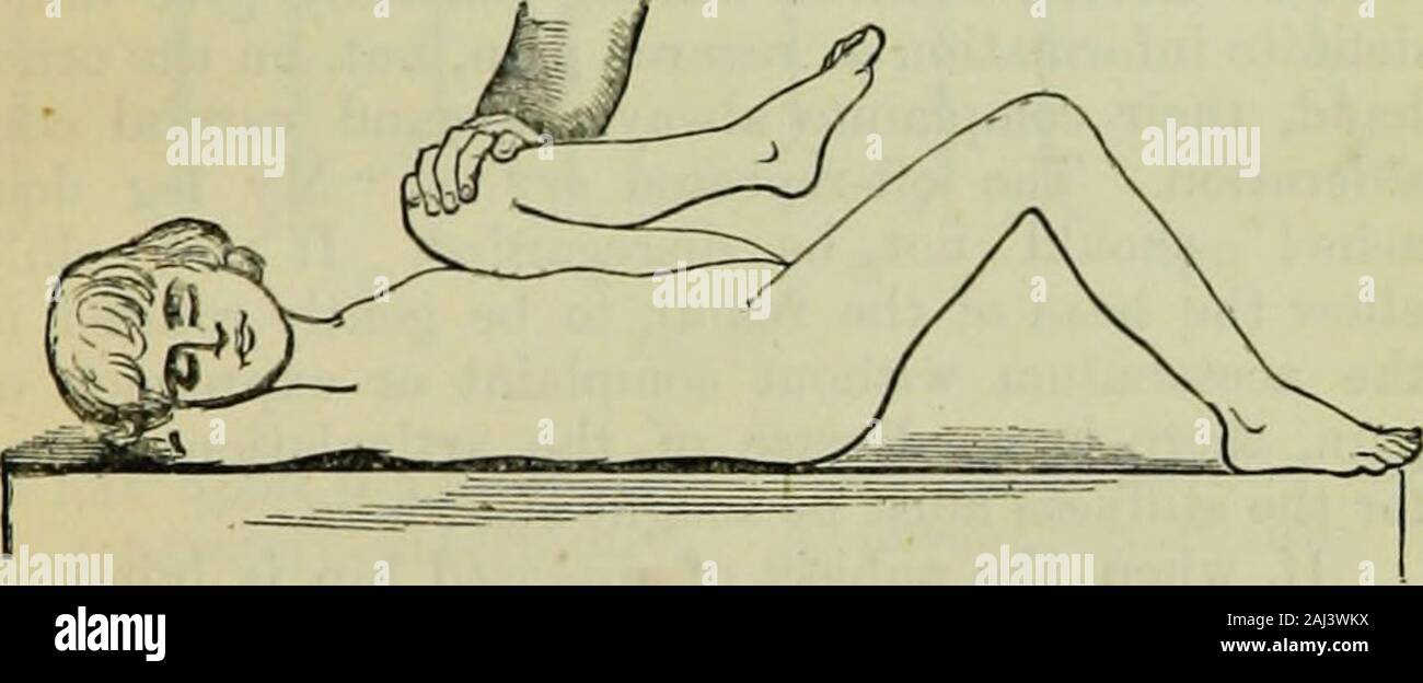 The surgical diseases of children . Fig. 71.—Loins flat, but Thigh cannot be brought down. place without suppuration, being due to arrested de-velopment. For making the diagnosis the child should beentirely stripped and placed supine upon a firm couch,or upon the table or floor. The diseased joint beingstiff, and- partially flexed, it follows that when both. Pig. 72.—Sound Thigh flered on Abdomeu for ascertainingexact amount of Deformity. thighs are brought flat down a compensating excavation(Fig. 70) is established at the loins, beneath whichthehand can be easily passed. This loin arch can be Stock Photo