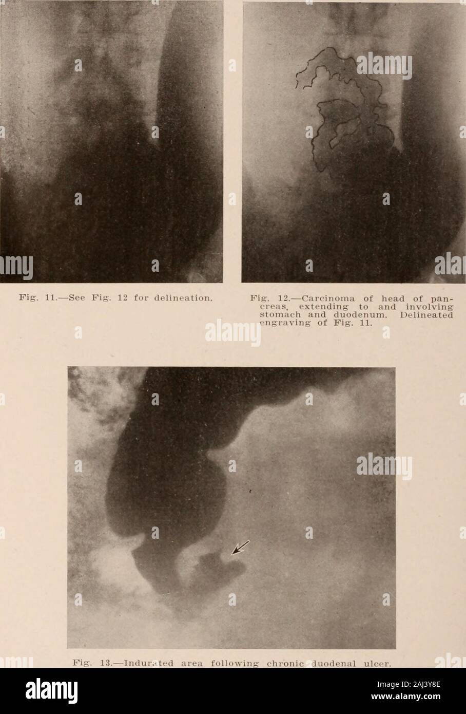 Interstate medical journal . Fig-. 10.—Peristaltic incisura of caput. A  rare phenomenon. peristalsis, antral dilatation, and six-hour residue.  Third, incisuramay be present, either single or bilateral; usually small,  sharplyoutlined, and occurring in