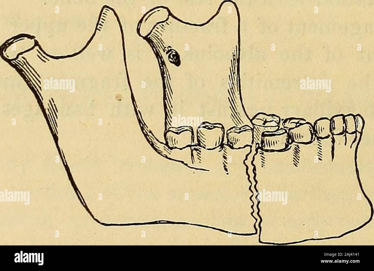 Maxillary fracture hi-res stock photography and images - Alamy