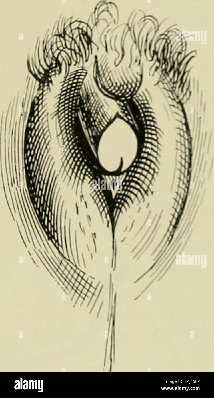 Hermaphroditismus beim Menschen . he Lancet 12./10. 1895, p. 917).(Beob. 1047.) 67jähr. Weib mit Backen- undSchnurrbart. Erreur de sexe, Weib. Penishypospadiaeus, großes gespaltenes Scrotum, nie-mals ein Geschleditstrieb. Man sah keinenGrund, diesen verkannten Mann aus dem weib-lichen Arbeitsasyl zu entfernen, da er sidiselbst für ein Weib hielt. Im Asyl in Kidderminsterzwitter erkannt. 1046. Stricker, W.: Virchows Archiv, Bd. XXCVI1I, S. 184. Eine literar-historische Studie über Hermaphroditismus. 1547. Stricker: Lehrbuch d. Histologie. Studien über Zwitterbildungen.Archiv f. prakt. Anat. Ber Stock Photo