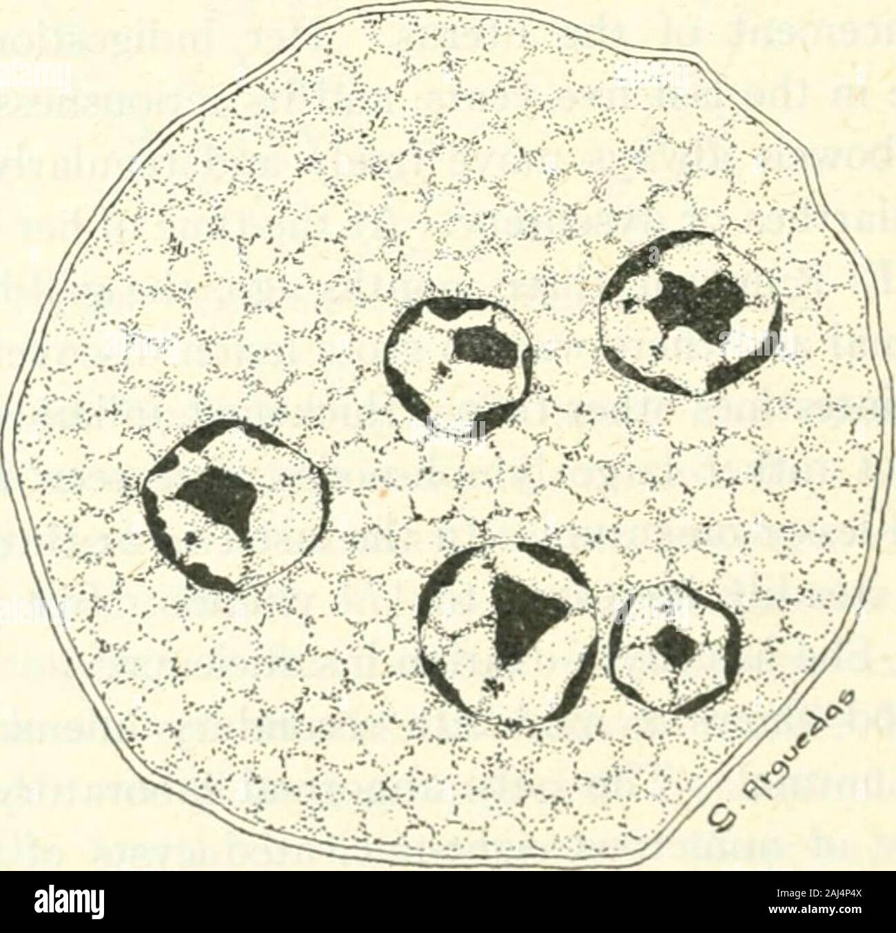 The Medical clinics of North America . Fig. 99.—Entamoeba coli, motile form.. Fig. 100.—Entamoeba coli, encysted form. whether this is a new species, hitherto confused with P^ntamcebacoli, will have to be made by the systematic protozoologist. At INTESTINAL PROTOZOA IN CLINICAL PRACTICE 413 present we classify them as E. coli of the Councilmania type.The variety is easily recognized and differentiated, but furtherstudy and confirmation is needed to establish its biologic separa-tion from E. coli. We have had no difficulty in curing thisspecies of infection with the same treatment used for E. h Stock Photo