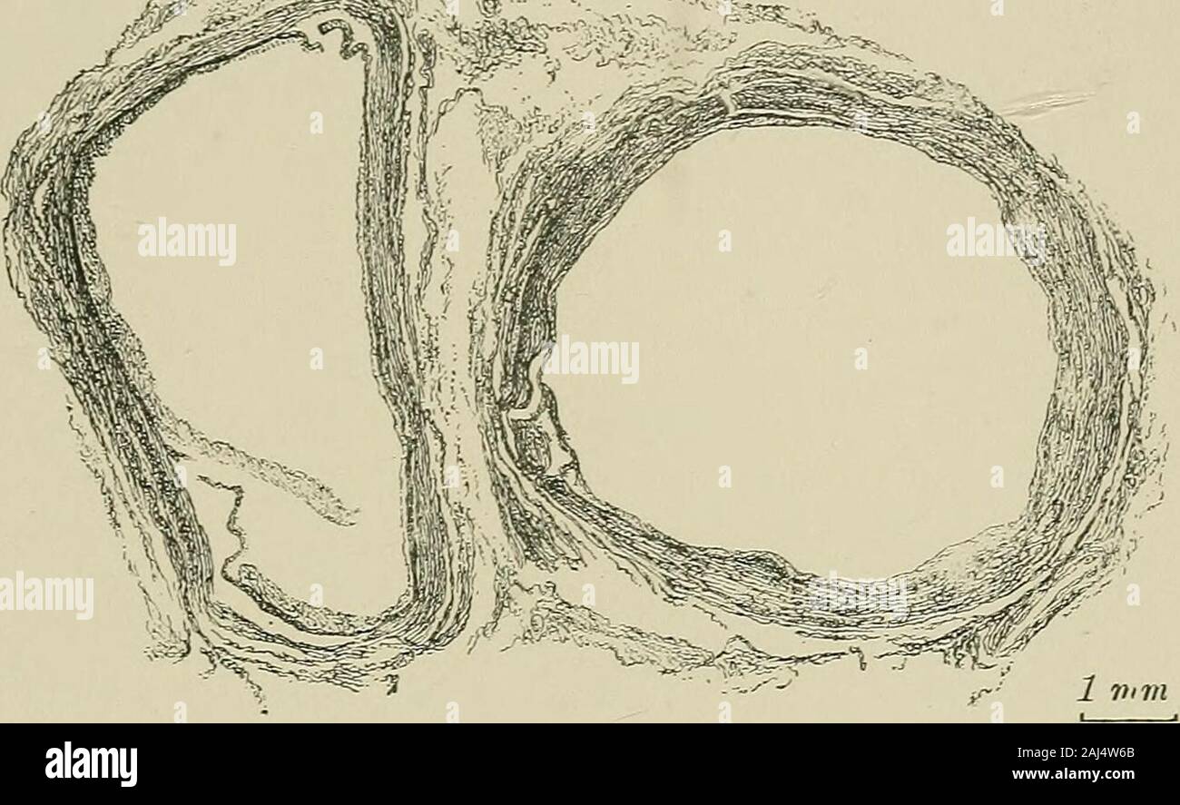 The origin of disease : especially of disease resulting from intrinsic as opposed to extrinsic causes : with chapters on diagnosis, prognosis, and treatment . (X 6.) Femoral artery and vein from an elderly man who died of Brights disease. Bothvessels were converted into rigid bony tubes by calcareous deposit, and had to be treatedwith acid before sections could be cut. The artery looks broken, the intima is irregularlythickened, and there are spots of degeneration of the muscular coat. The intima of thevein is greatly and irregularly thickened. At one place the intima and muscularis arebroken Stock Photo