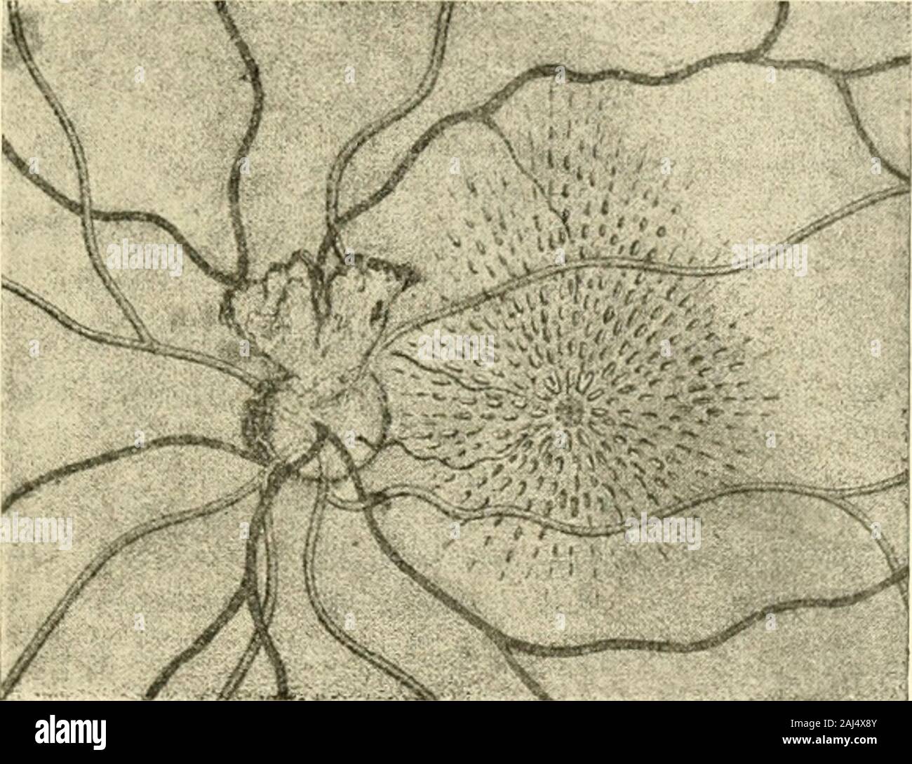 Die Neurologie des Auges Ein Handbuch für Nerven- und Augenärzte . Fig. 107. Degenerative Veränderung sämtlicher Netzhaut-Nach Hirschberg, C. f. A. XXI, 206. artenen. Die Sternfigur an der Macula. 317 Jj 304. Hinsichtlich der anatomischen Erklärung der Sternfigurist noch keine völlige Einigung erzielt. 1) immer (1064) untersuchte Augen, in denen die charakteristischenFlecke in der Gegend der Macula bei Retinitis albuminurica festgestelltwaren. Mikroskopisch fanden sich Ansammlungen von durch Osmiumsäureschwarz gefärbter Fettkörnchenzellen in der äusseren Faserschicht der Maculabis gegen den Gr Stock Photo