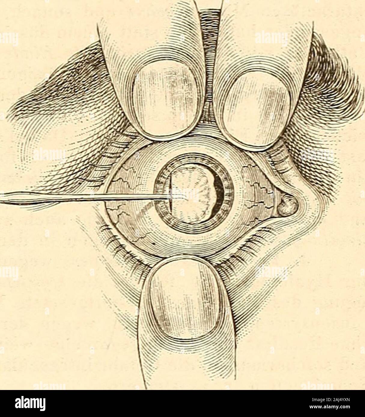 Lehrbuch der praktischen augenheilkunde . Anlagerung regressiver Staartheile getrübt undmehr weniger steif oder zähe geworden, so tbut man am besten, statt derSichelnadel ein Irishäkchen flach einzuführen, die Kapsel nahe an ihreminneren Rande einzuhaken, das Instrument dann langsam um seine Axezu drehen, um mehr Anhaltspunkte zu gewinnen und seine scharfe Spitzein Kapselfalten zu hüllen, und sodann unter ganz allmälig steigendem vor-sichtigen Zuge gegen die Cornealwunde hin zu bewegen. Ist die Vorder-kapsel durch Anlagerungen schon recht zähe geworden, so gelingt es garnicht selten, sie im Zu Stock Photo