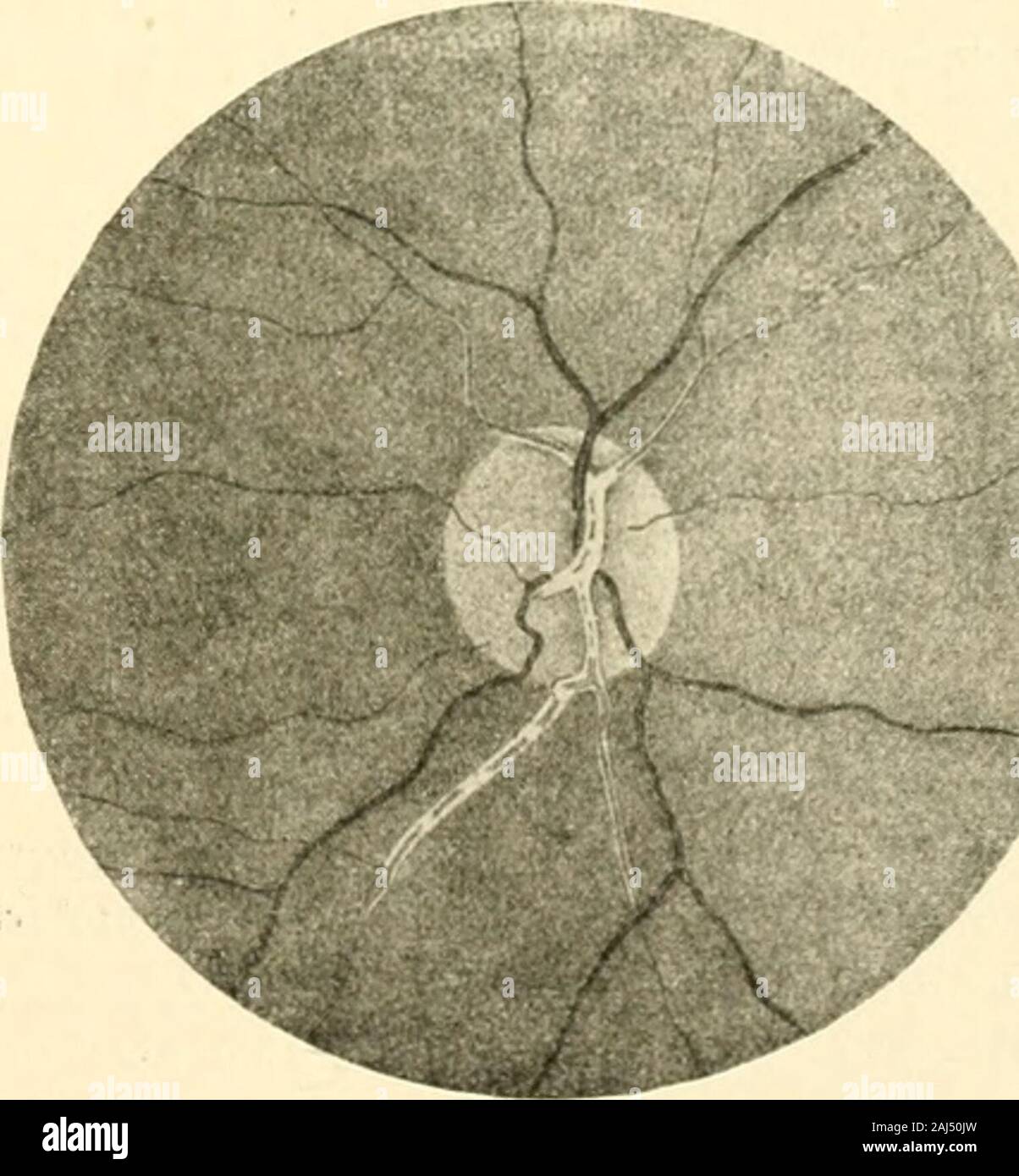 Die Neurologie des Auges Ein Handbuch für Nerven- und Augenärzte . fe  wieder gleichzeitig mit Ver-besserung des ophthalmoskopischen Bildes. Das  Herz und die grossen Blutgefässewurden nach sorgfältigster allge-meiner  Untersuchung gesund be-funden, und