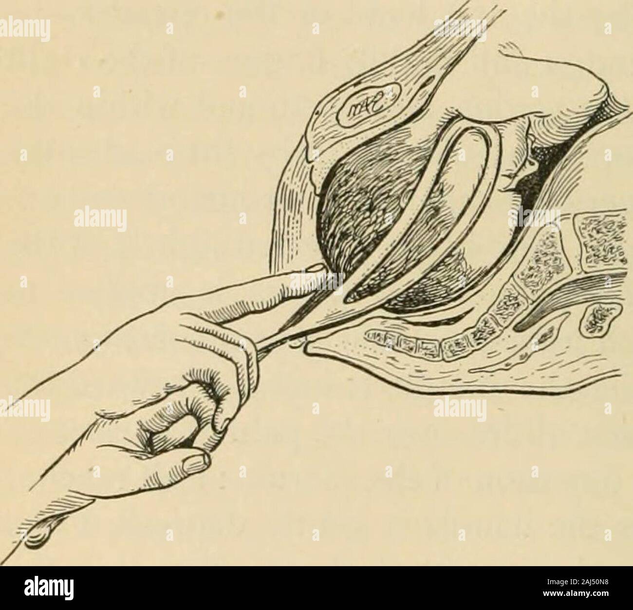 A manual of obstetrics . he fetal head lie in theleft oblique diameterof the pelvis, as inthe second (R.O. A.)and fourth (L. O. P.)positions of the ver-tex, the left blademust be rotated for-ward. This rotationis accomplished notthrough the agencyof the handles, butby the fingers of thevaginal hand — theleft in rotation ofthe right blade, and the right when the position of the leftblade must be altered. The biparietal diameter now beinggrasped, the instrument is readily locked and traction maybe made (Fig. 148). Method of Delivery by the Forceps in the First Position{L. O. A.) of the Vertex.—T Stock Photo