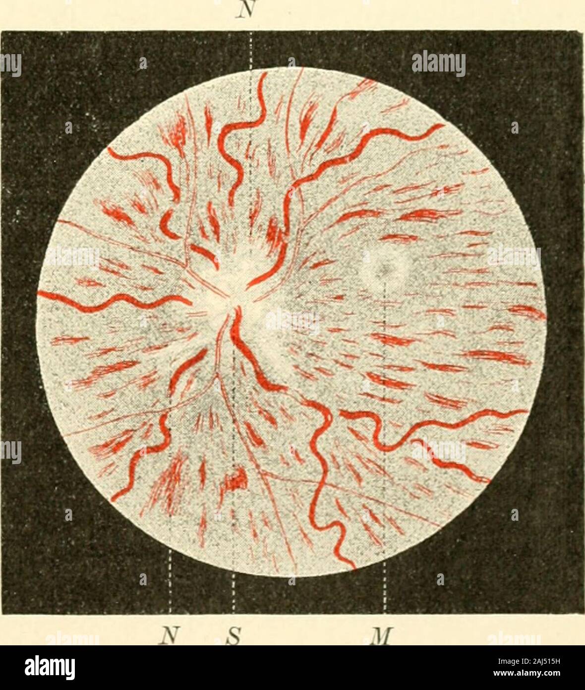 Die Neurologie des Auges Ein Handbuch für Nerven- und Augenärzte . inae er-scheinen nach Mich el (552). welcher dieses Krankheitsbild zuerst fixiert hat,die Venen hochgradig geschlängelt(vergl. Fig. 94), von wurstähn-lichem Aussehen, die Blutsäule inderselben ist ungemein verbreitertund von fast schwarzroter Fär-bung. Schmälere und breitereStellen wechseln miteinander ab.Im Gegensatze hierzu steht dasVerhalten der Arterien, welcheverengt und auffallend geradliniggestreckt erscheinen. Die Ein-trittsstelle des Sehnerven ist wievon einer Blutlache überzogen,welche die Gefässe vollständig ver-deck Stock Photo