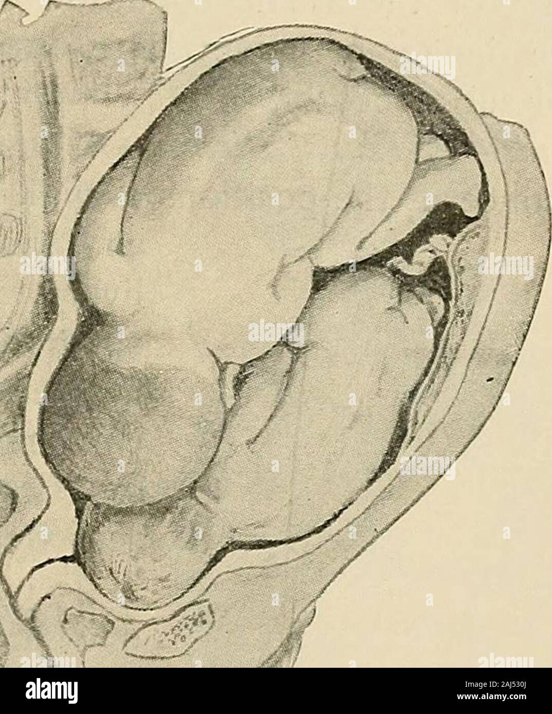 A manual of obstetrics . strosities according to thedegree of interference with the process. (3) An increasedtC7idcucy to diseases of the niendnanes. Hydramnios is a notinfrequent complication of multiple pregnancy resultingfrom some interference with the circulation of the parts.(4) Ufa/positions and nia/presentations. Transverse presen-tation of the fetus is quite a common complication of twingestations: it occurs once in about 22 cases; presentationof the breech is also frequent. PLURAL BIRTHS. 485 TJic Clinical ATanifcstatioiis of Labor in Multiple Preg-nancy.—The labor is precisely like t Stock Photo