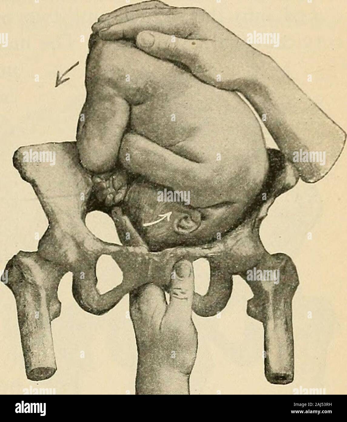 A Manual Of Obstetrics On Of Ergot Or In Neglected Cases D Any