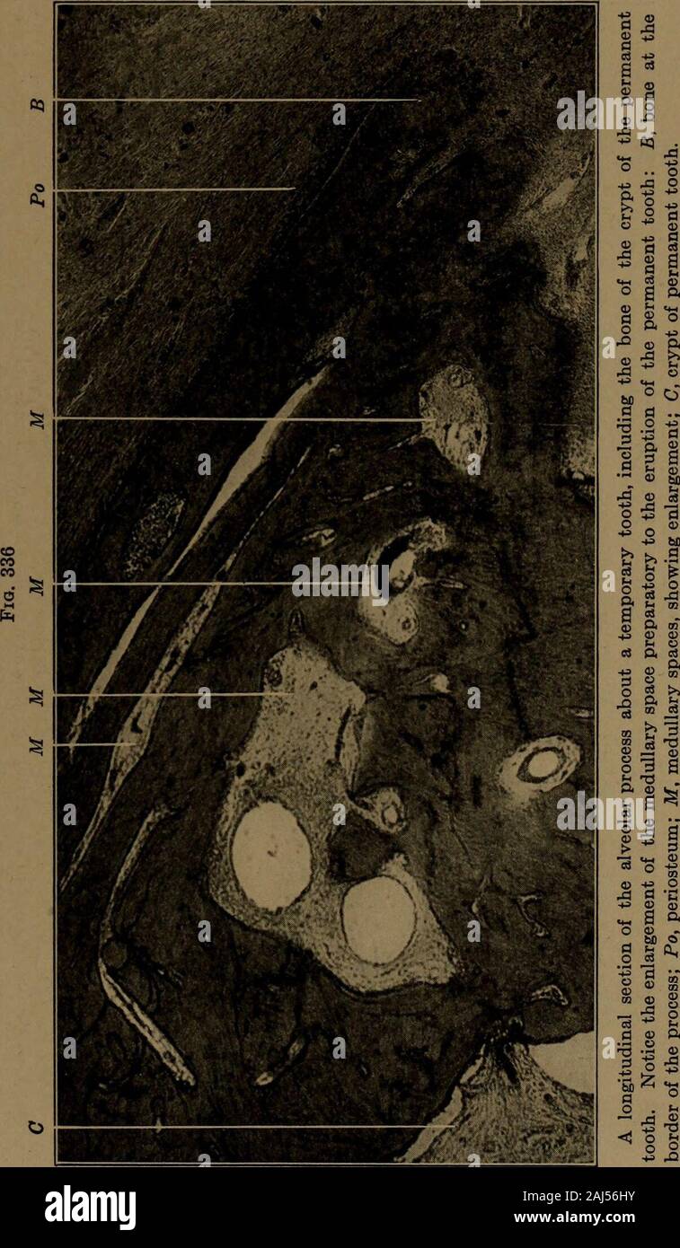 A text-book of dental histology and embryology, including laboratory directions . A longitudinal section through the temporary alveolar process, which is growingocclusally to follow the temporary tooth. It is from the same series as Fig. 334, butshows more of the bone. Study the absorptions and rebuildings, as shown in the arrange-ment and character of the lamella?. Pd, peridental membrane: Po, periosteum. THE GROWTH OF THE JAWS 419. 420 THE TEETH AND DEVELOPMENT OF THE FACE Stock Photo