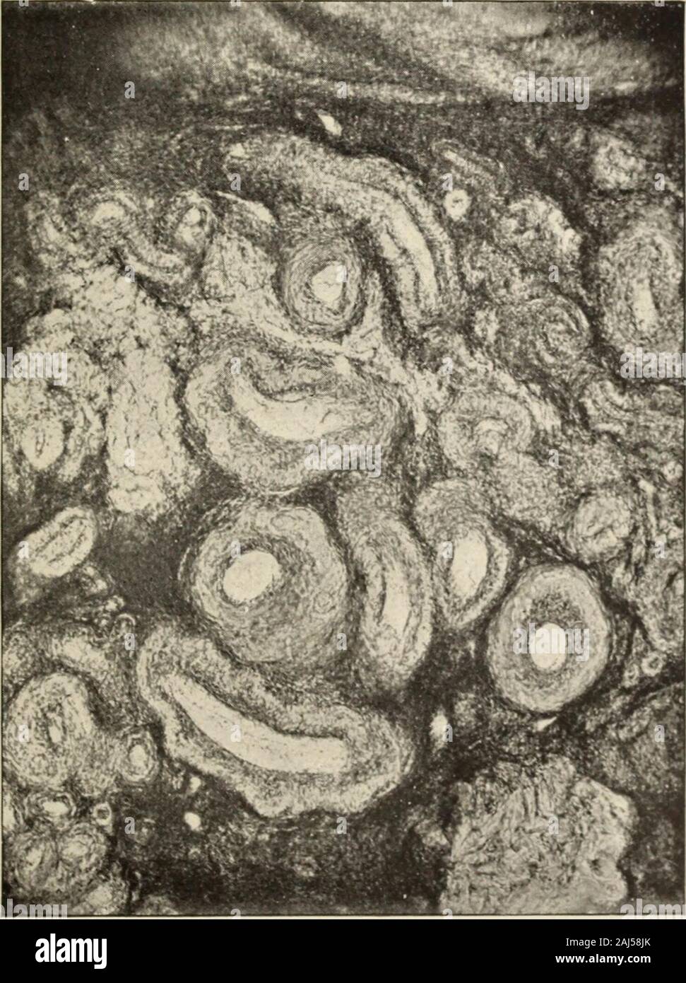 The Hahnemannian monthly . Ovarian cortex transformed into fibrous tissue.Multiplied 200 times. Fig. 8.. Endoarteritis obliterans and arterio-sclerosis. Beginning gyroina.Multiplied 50 times. 1894.] Some Pathological Conditions of the Ovaries. 89 stroyed. Besides, it is these conditions with which pre-eminentlyare associated the distressing and persistent pains in the ovary whichhave often induced the decision to extirpate the gland. It has beenfound also that pathological changes have taken place in all thetissues of the ovary where the gyroma is found. The appearancepresented by this conditi Stock Photo