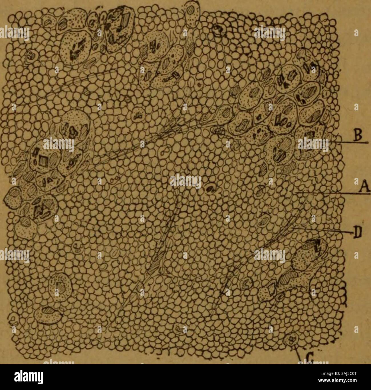 Manual de anatomÃ-a patolÃ³gica general : seguida de un resumen de microscopia aplicada a la histologÃ-a y bacteriologÃ-a patolÃ³gicas . Estas presunciones nuestras han sido confirmadas por algunos autores, tales como Kolosow,<iuien, Ã¡ beneficio de un mÃ©todo de coloraciÃ³n nuevo, ha logrado discernir los filamentos de uniÃ³nque reÃºnen los bordes de las cÃ©lulas endoteliales.. Figura 13. FOCO HEMORRÃGICO DE LARGA FECHA SITUADO EN EL ESPESORDE UNA NEOFLASIl .4, HematÃ-es decolorados; B, Gruesos leucocitos teÃ±idosde amarillo por la substancia colorante sanguÃ-nea y concristales de hematoid Stock Photo