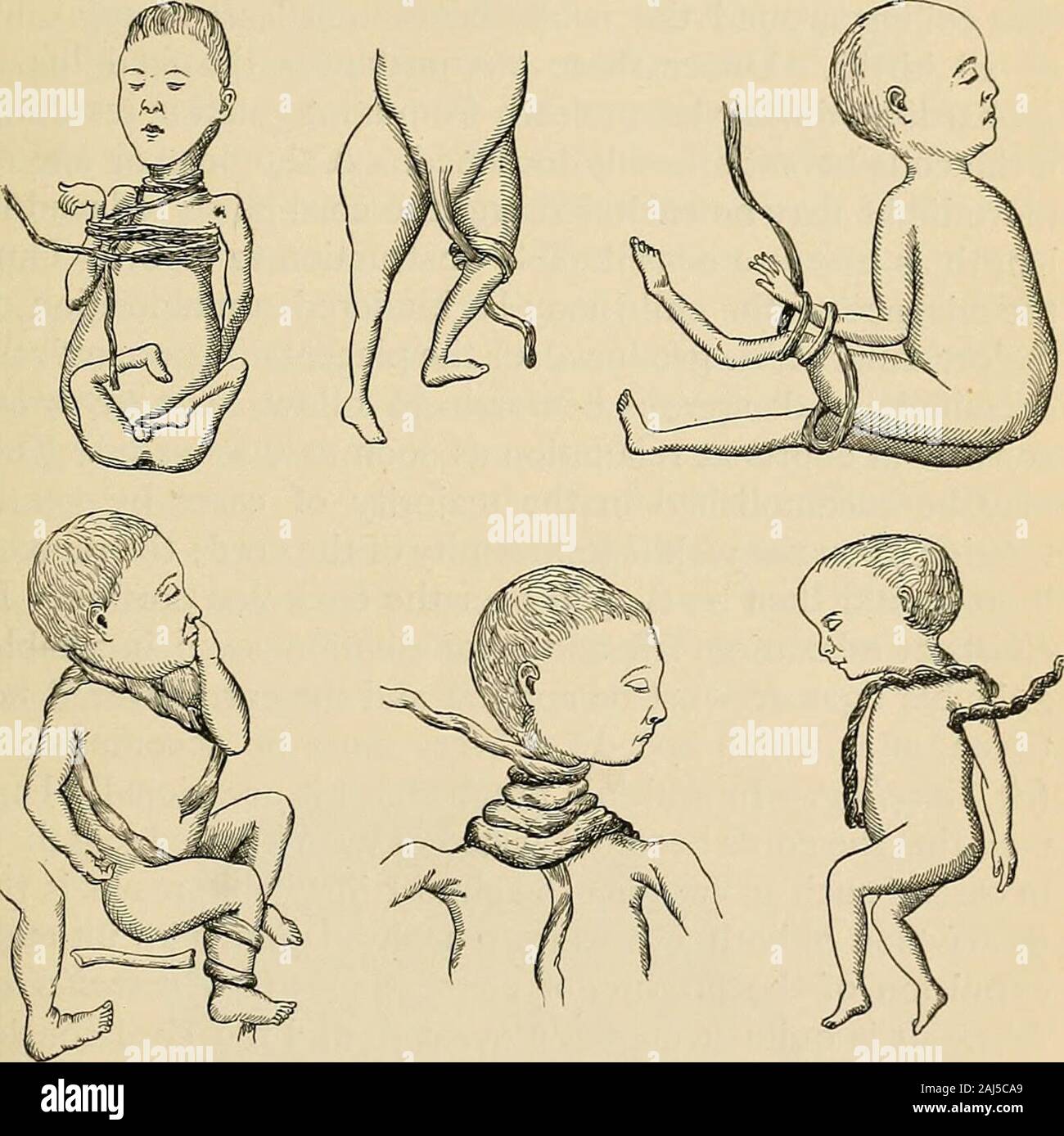 A Manual Of Obstetrics Ulted In Fetal Death Long Before Others Hadformed Schauta A Curious Fact Is The Greater Frequencyof Torsion In The Cords Of Male Fetuses When Present In Aminor A Manual Of Obstetrics Ulted In Fetal Death Long Before Others Hadformed Schauta A Curious Fact Is The Greater Frequencyof Torsion In The Cords Of Male Fetuses When Present In Aminor