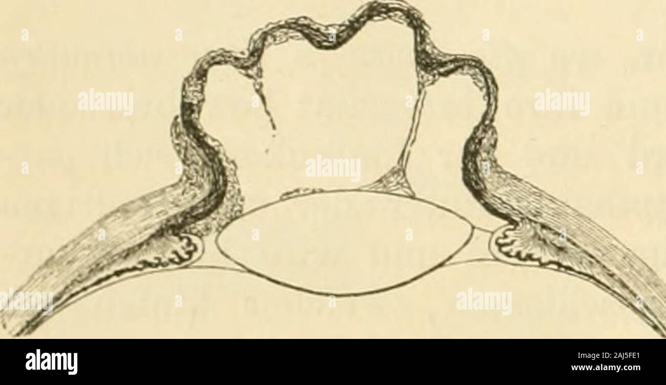 Lehrbuch der praktischen augenheilkunde . fernte Aehnlichkeit mit einer Beeren-traube, daher der Name : Traubenetaphy-lom, Staphyloma iridis racemosum. Das Staphylom der Iris kann berstenund sich wieder füllen, oder aber nacherfolgter Berstung zusammengefaltetbleiben und zur Grundlage einer flachen Narbe werden. Oft jedoch wucherndie Wände des Irisstaphyloms fort und wandeln sich in eine mehr wenigerdicke Narbenmembran tun, die ständig ist, es hat sieh das Irisstaphylom inein totales Narbenstaphylom der Hornhaut umgebildet. Der Bulbus bleibtdann in der Regel vergrösserl , obgleich die inneren Stock Photo