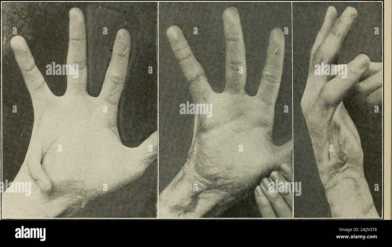 Plastic surgery; its principles and practice . Fig. 791.—Method of rebuilding a hand (Burkard