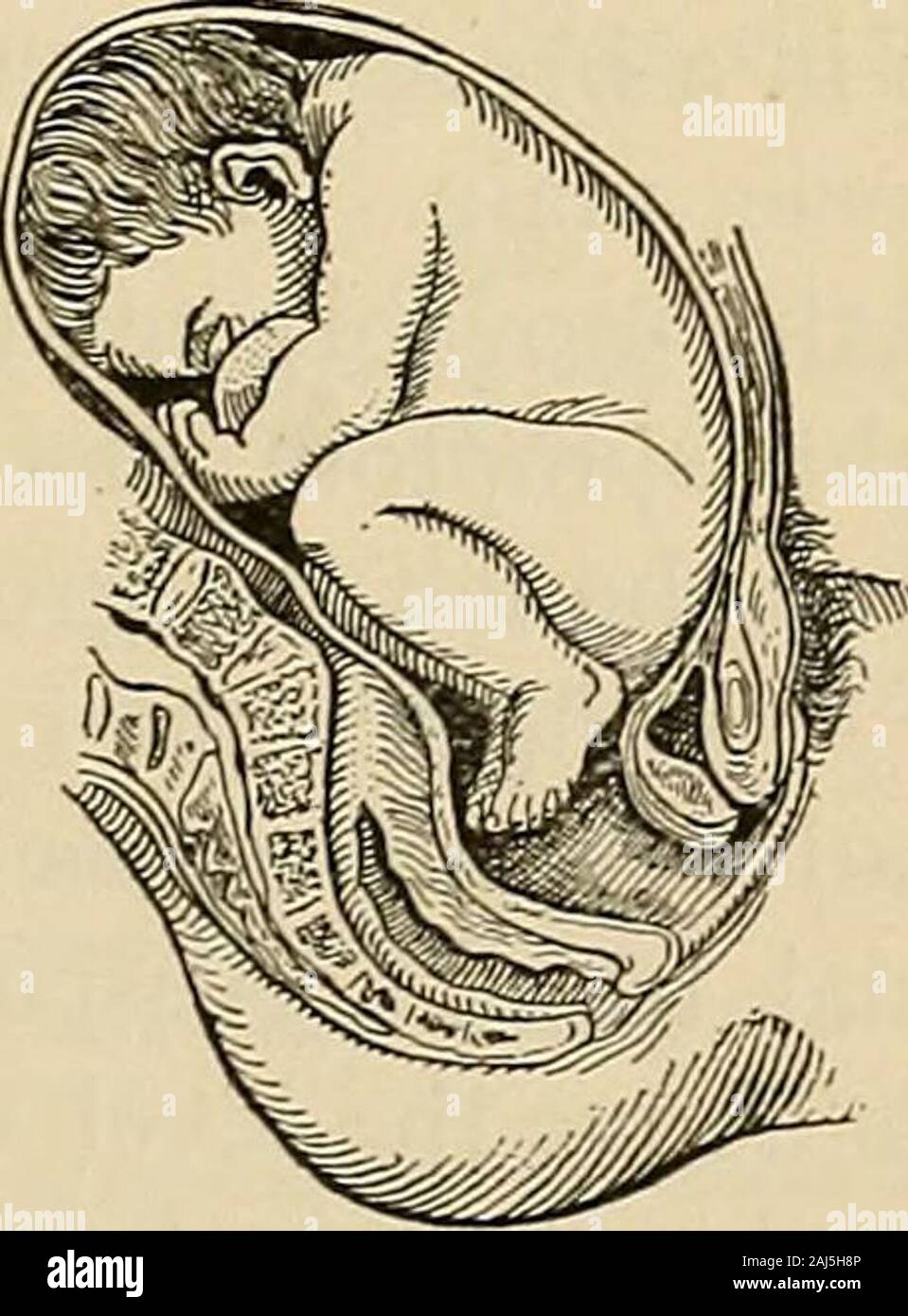 A manual of obstetrics . Fig. 67.—Knee presentation.. Fig. 68.—Foot