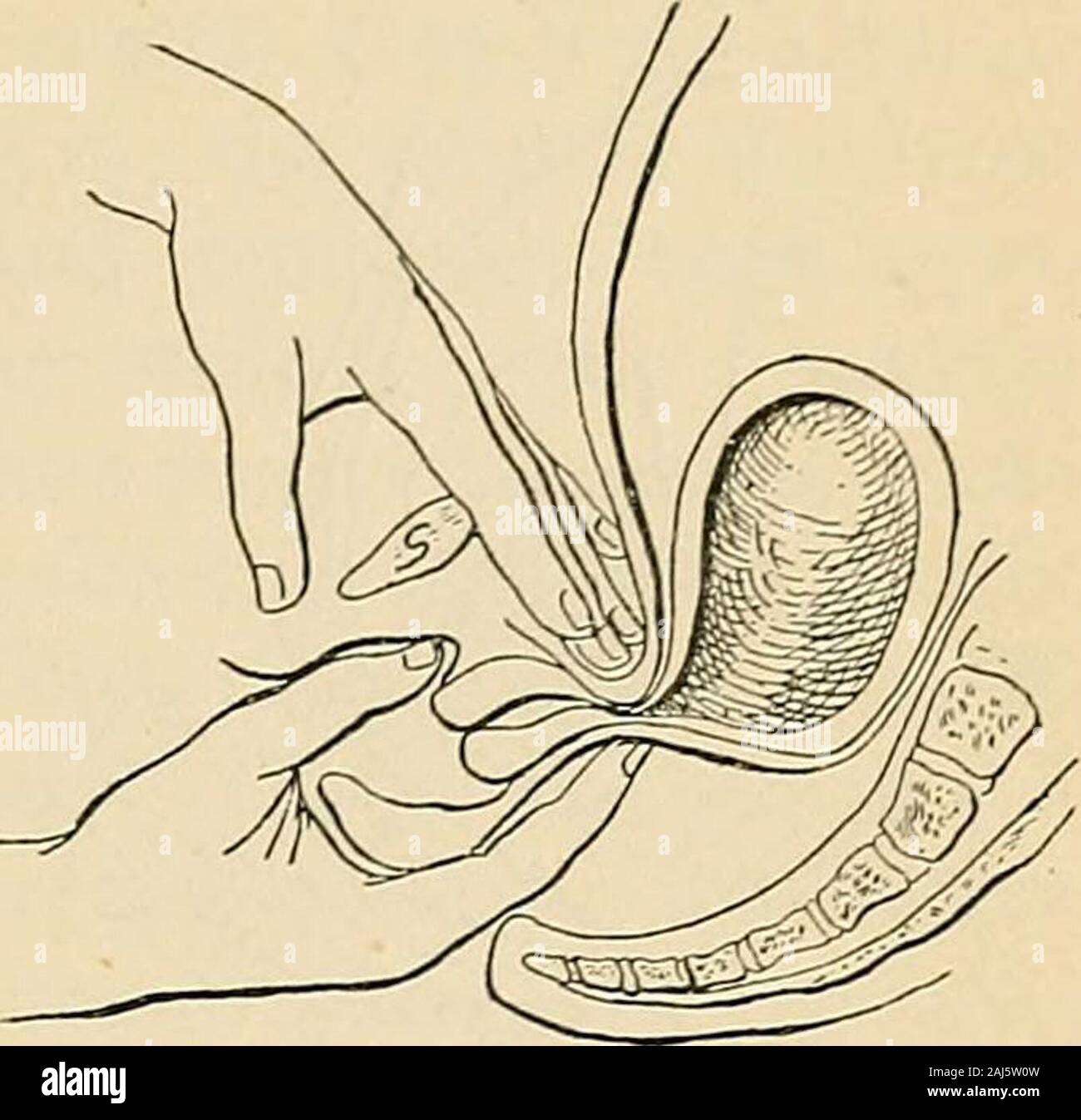 A manual of obstetrics . her conditions causing local rise of tem-perature are—i. Vaginitis; 2. Congestive diseases of thepelvic viscera. (5) Goo dells Sign.— Velvety softness of the cervix uteriis a truly valuable, although not absolutely diagnostic,sign of gestation, resulting from the edema of the tissuesof the cervix. It may be present as early as the second orthird week of pregnancy. Professor Goodell formulateda so-called ready rule of practice as follows : When the cer-vix is as hard as the tip of ones nose pregnancy presumablydoes not exist, but if it be as soft as ones lips, the exist Stock Photo