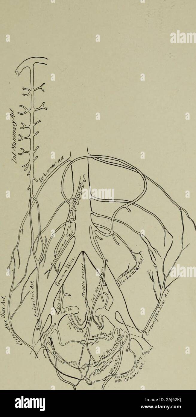 Transactions of the Southern Surgical and Gynecological Association . aortic bifurca-tion and both common iliacs. The peritoneum over the siteselected is elevated, snipped and stretched, the artery byblunt dissection is isolated from the vein and elevated, theloaded ligature carrier directed toward the patients left ispassed under the artery, and the iliac doubly tied and inter-locked by heavy braided silk. One hourglass suture sufficesto repair the peritoneal rent. The table is brought to a level.The abdomen closed in the usual manner. The entire proced-ure can be accomplished in a few minute Stock Photo