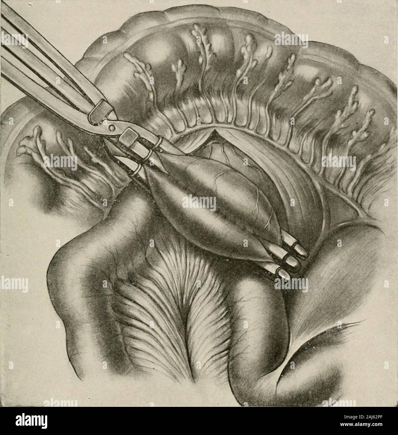 Surgical treatment; a practical treatise on the therapy of surgical diseases for the use of practitioners and students of surgery . through the transverse mescolon. The incision shouldbegin about 5 cm. (2 inches) below the ensiform cartilage and extend belowthe level of the umbilicus. The abdomen is opened about 2 cm. (% inch)to the right of the median line, by retracting outward the rectus muscle. The THE ABDOMEN 763 stomach is lifted forward with the transverse colon and the great omentum,and turned upward over the upper end of the abdominal opening. Theomentum is pressed upward and the lowe Stock Photo