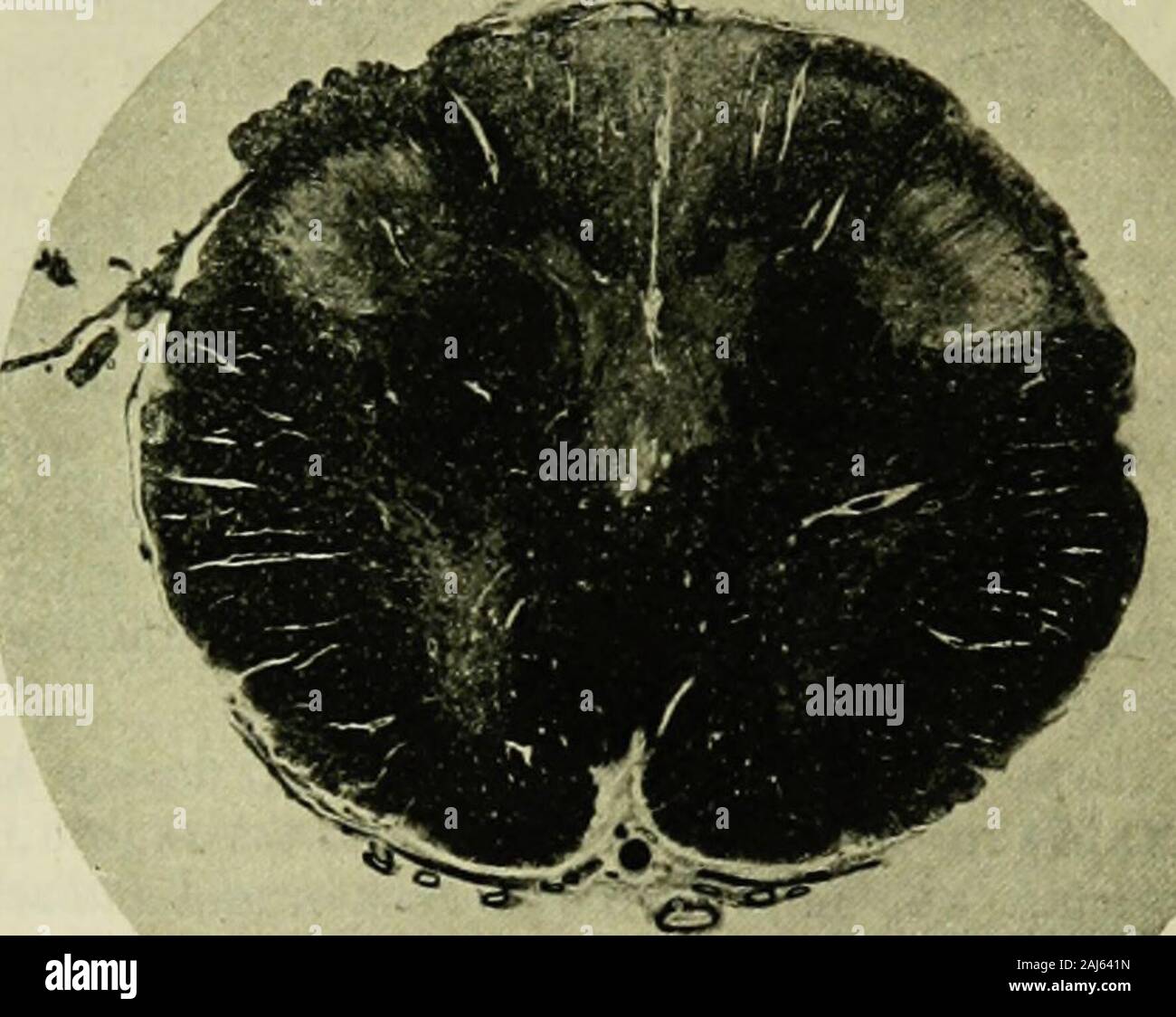 Diagnostik der Geisteskrankheiten für praktische Ärzte und Studierende . ach dem Centralcanal gelegenen Drittel eine Zahl von Fasernerhalten sind. Die Randdegeneration ist ganz ausgeprägt, sie ist am stärksten anden seitlichen Theileu der Seitenstränge. Rechts erscheint im Gebiet der Seiten-stränge eine dem Hinterhorn anliegende Partie weniger gefärbt und erweist sich alsleicht degenerirt. Anscheinend ist dabei der Pyramidenseitenstrang betheiligt. Im Lendenmark (Fig. 13 d) betrifft die Degeneration hauptsächlich diehinteren zwei Drittel der Hinterstränge. Die Randdegeneration ist noch deut- Stock Photo