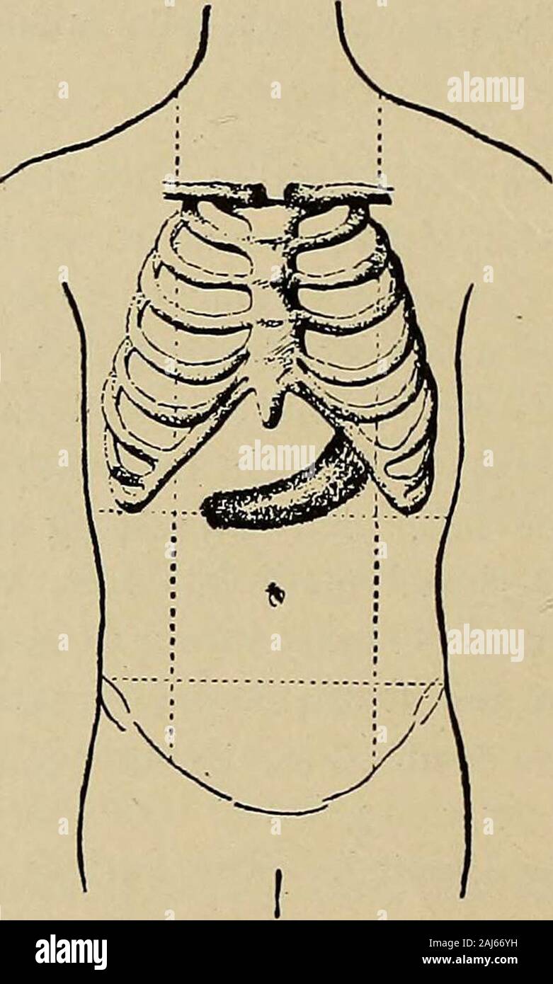 Cancer of the stomach : a clinical study . d, resisting edge which we had felt so plainlyduring life corresponded to the greater curvature. The orifices werenot narrowed. The walls were from 8 to 10 mm. in thickness at thecardia, and 13 to 14 mm. at the pylorus. The lining membrane ofthe stomach was smooth and showed no erosions. On microscopical 86 CANCER OF THE STOMACH examination, the mucous membrane was almost entirely deficient. Thesubmucosa was occupied by large groups of cancer cells between strandsof connective tissue. The layers of the muscular coat were muchhypertrophied, and, invadi Stock Photo