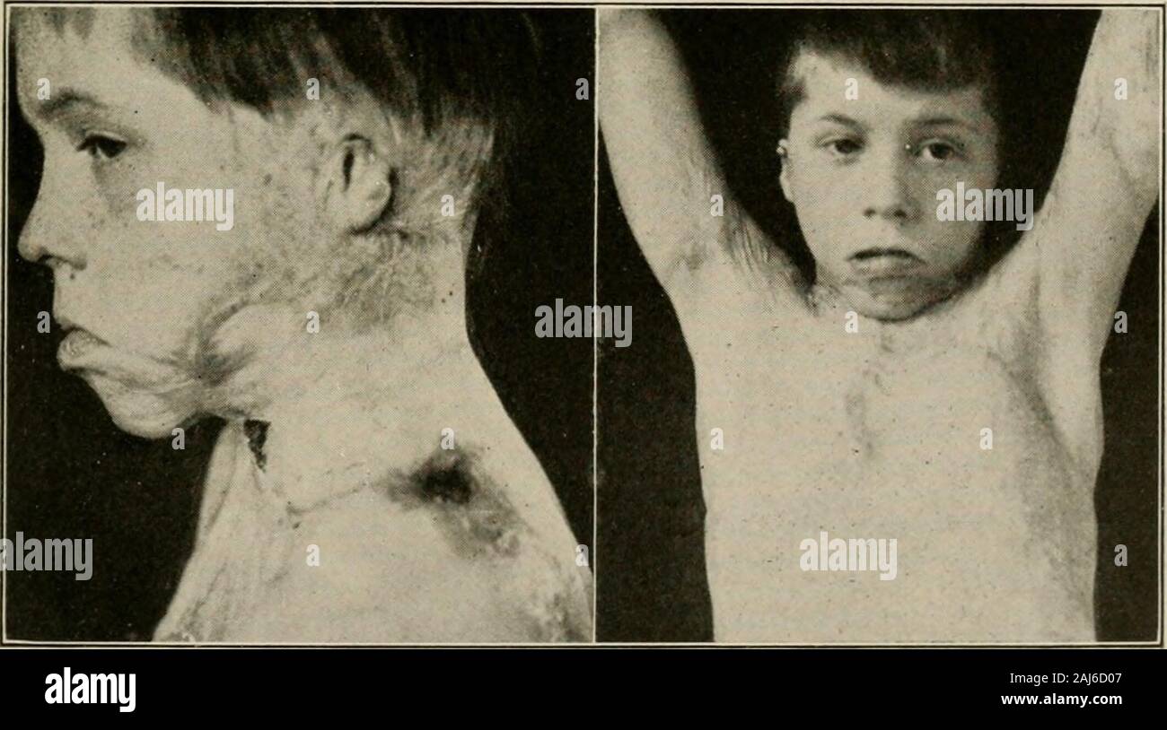 Contracture Scars Face Burn scar contracture hi-res stock photography and images - Alamy