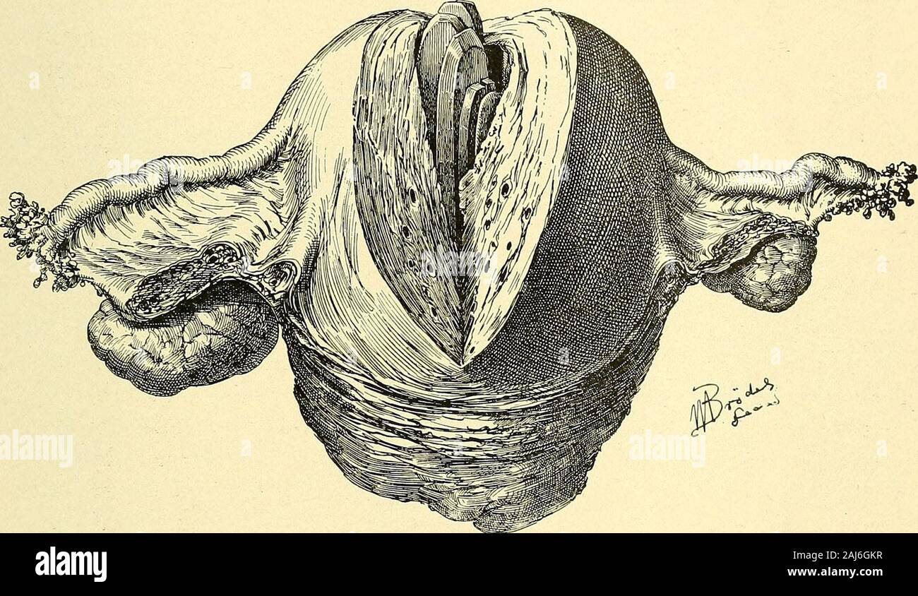 Operative gynecology : . of purulent fluid,and the enlarged soft uterus was removed. On section its walls were foundto contain numerous small abscesses; the alcoholic specimen measured 13 by9 by 6 cm.; its cavity was 9 cm. long and contained six pieces of wood (parts Fig. 321.—Goodell-El-linger Dilator, withSpring between theHandles, but with-out a Ratchet. The corrugations onthe blades prevent slip-ping during (he dilatation.•V ordinary size. METHOD OF DILATING. 581 of an elm tent), which, united, formed a perfect cone with a hole perforatingits base. The uterine walls were extensively necrot Stock Photo