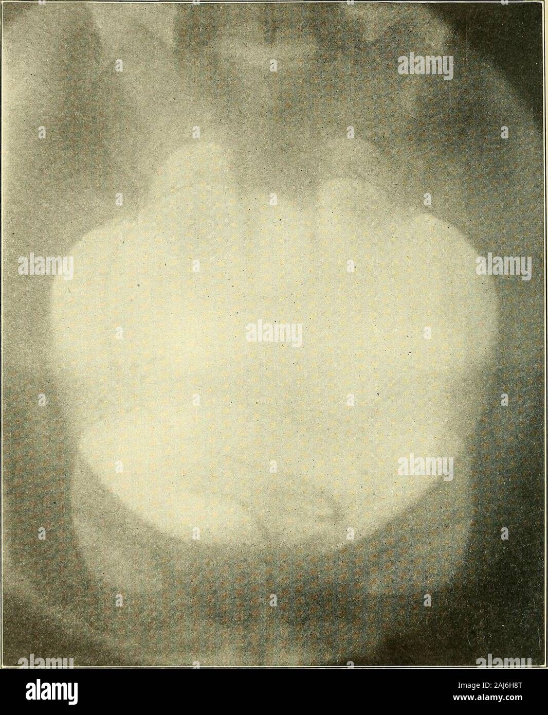 Operative gynecology . Fig. 318.—Phleboliths Lying near the Ureteral