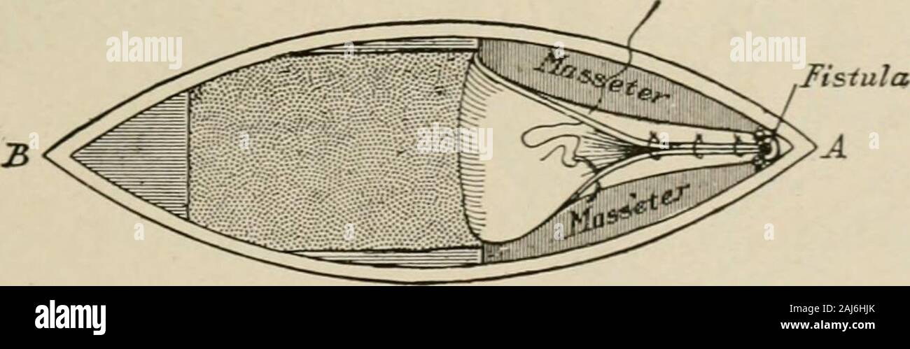 Plastic surgery; its principles and practice . Pig. 697.—Brauns operation for fistula of Stensons duct (Binnie).—i. Make theincision AB which divides all the tissues except the masseter, and the buccal mucosa. Dis-sect the fistulous opening free from the skin. 2. Retract the tissues and form a flap ofmucosa of the desired length and width, with its pedicle at the anterior border of themasseter. 3. Turn the flap back and suture its free end to the fistula, and its edges to-gether to form a tube. Close the skin wound. The ends of this suture are left long, and to it is tied a loop of Xo. 5,lo-da Stock Photo