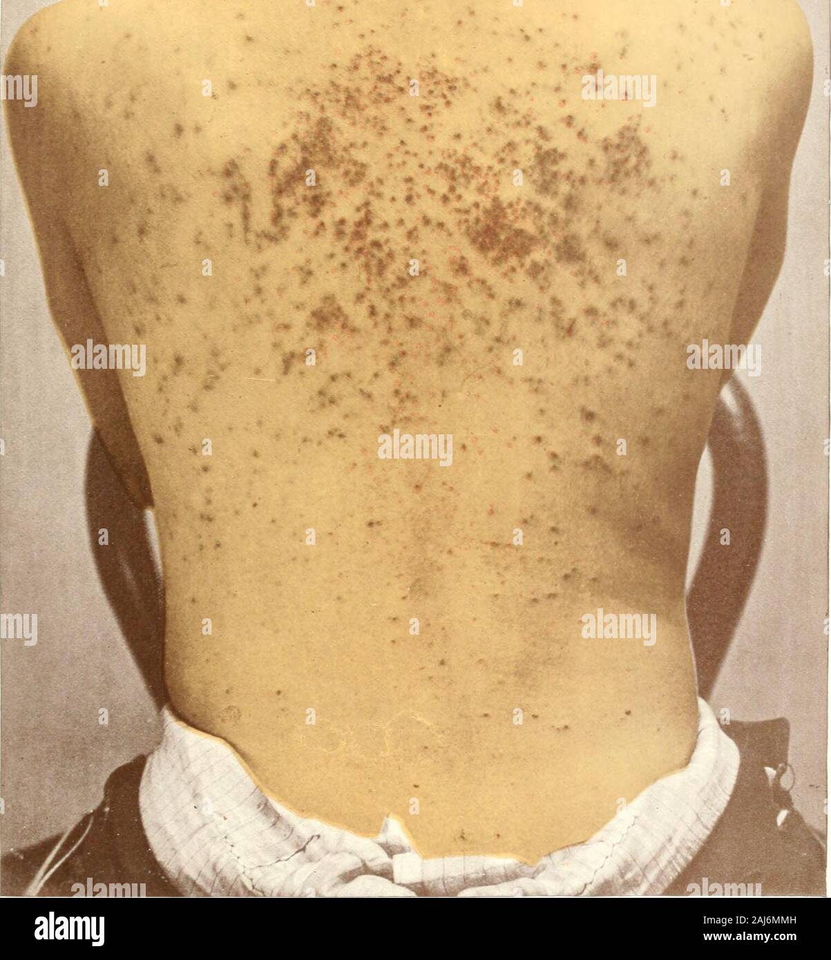 Photographic atlas of the diseases of the skin; a series of ninety-six plates, comprising nearly two hundred illustrations, with descriptive text, and a treatise on cutaneous therapeutics . form diffused patches, which soon present the moistexuding surf^ice, which is the most charaderistic symptom of ecze-matous inflammation. It is for this reason that the old term lichensimplex has become obsolete, and the eruption is now generallyrecognized as a form of eczema. In scabies urticaria and prurigothe papular form of eczema is often artificially produced by theirritation of the skin resulting fro Stock Photo
