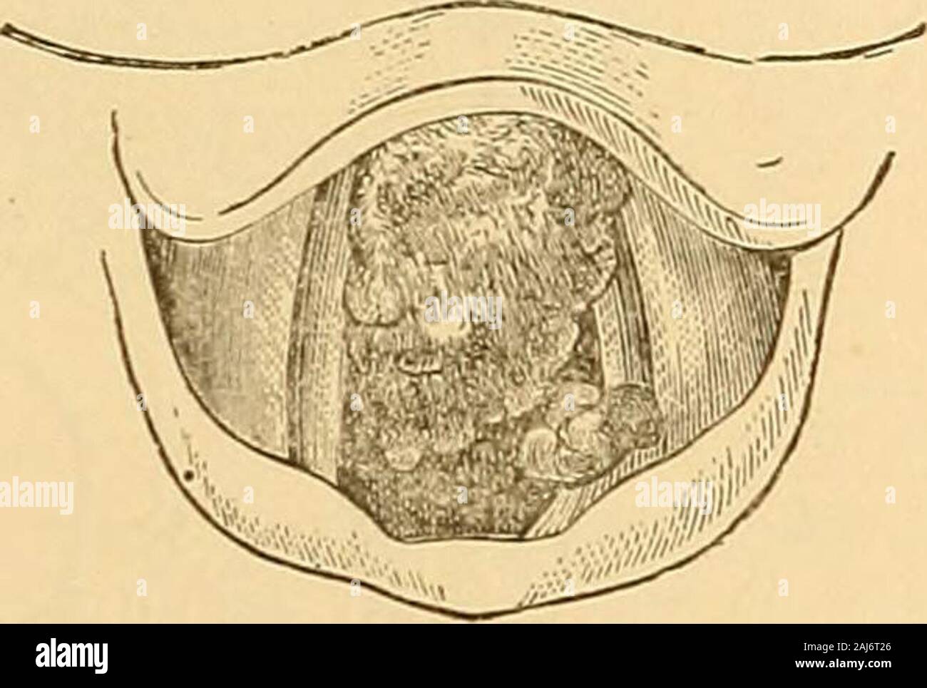 Clinical lectures on the principles and practice of medicine . Fig. 13. Fig 14. As the use of the laryngoscope extends these will of course become morenumerous. The rendering ulcers and morbid growths visible by thelaryngoscope, not only establishes an exact diagnosis, but permits of thedirect application of means for their cure or removal. Fig. *7. View of the healthy larynx with the laryngoscope, when the vocal cordsare closed as in sounding high notes.—(Czermak.) Fig. 8. Another view of the healthy larynx during ordinary breathing.—(Czermak.)Fig. 9. Another view during deep inspiration, wit Stock Photo