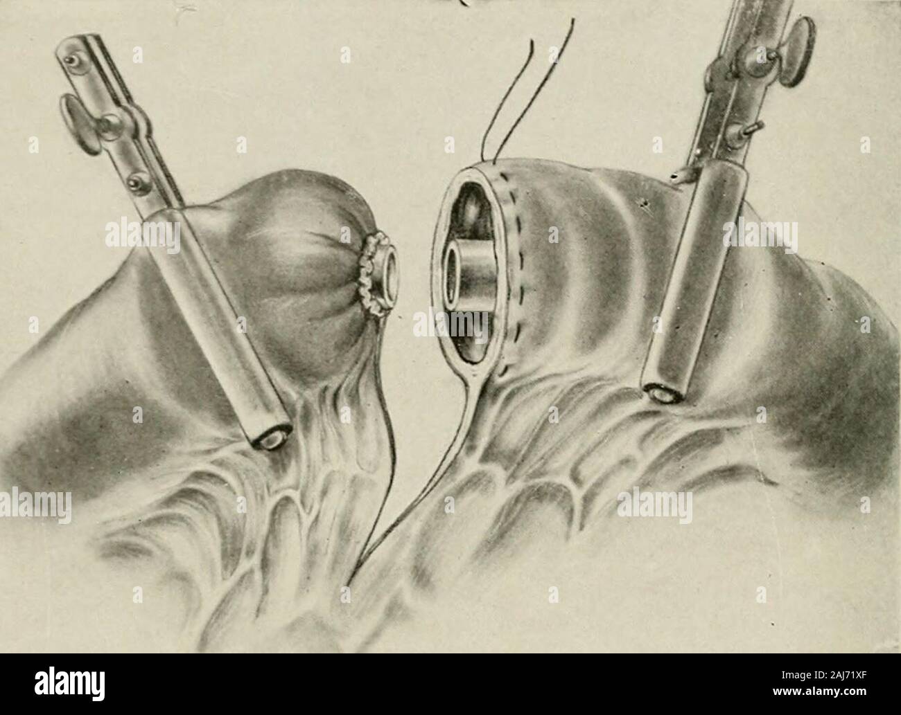 Surgical treatment; a practical treatise on the therapy of surgical diseases for the use of practitioners and students of surgery . Fig. 1340.-—Anastomosis Buttons of Murphy. forceps removed and the two halves pressed together. The mesenteryis then sutured. A few interrupted musculoserosa sutures may be added(Fig. 1342) although not considered necessary. In this operation careshould be taken that the button fits easily, that the pucker caused by thepurse-string is evenly distributed, that the ends of the suture are cut short, 670 SURGICAL TREATMENT and that serosa is opposed to serosa as the p Stock Photo