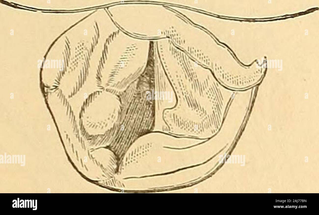 Clinical lectures on the principles and practice of medicine . Fig. 13. Fig 14. As the use of the laryngoscope extends these will of course become morenumerous. The rendering ulcers and morbid growths visible by thelaryngoscope, not only establishes an exact diagnosis, but permits of thedirect application of means for their cure or removal. Fig. *7. View of the healthy larynx with the laryngoscope, when the vocal cordsare closed as in sounding high notes.—(Czermak.) Fig. 8. Another view of the healthy larynx during ordinary breathing.—(Czermak.)Fig. 9. Another view during deep inspiration, wit Stock Photo