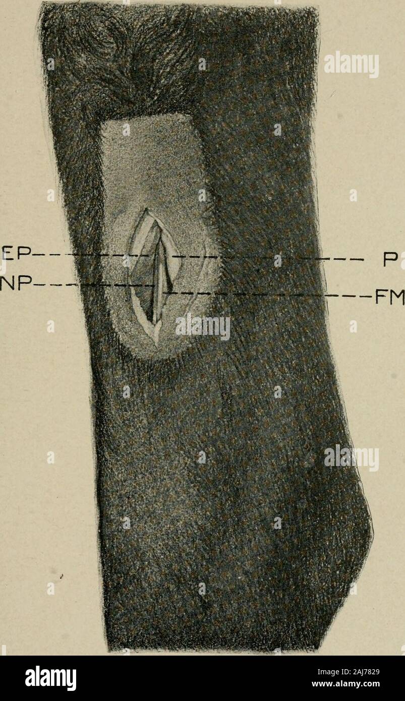Surgical and obstetrical operations . Pirate XXXII.Anterior Tibiai, Neurotomy. EP, extensor pedis muscle; P, peroneusmuscle; NP, deep branch of the peroneal oranterior tibial uerve ; FM, flexor metatarsimuscle.. ANTERIOR TIBIAL NEUROTOMY. 183 out prominently, in fat horses it is surrounded by a largeamount of adipose tissue. Cut through this fat and con-nective tissue and expose the tibial nerve, 71^ Plate XXXand NS, Plate XXXI, to view ; immediately before it liesthe plantar vein and on the lateral side is situated the re-current tibial artery, SA, Plate XXXI. The cross sectionin Plate XXXI i Stock Photo