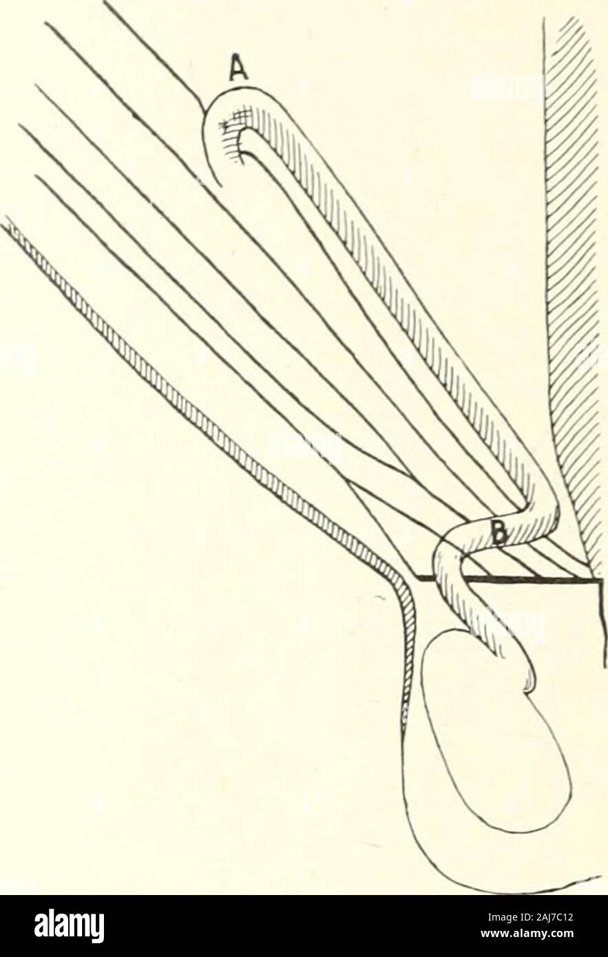 The medical age : a semi-monthly journal of medicine and surgery . ing the cord within the peritoneum. A diagram-matic representation of these methods follows. Fig. 3 (Halsteads operation)shows the cord placed between the external oblique muscle and the integu-ment, passing outside the external ring. In Fig. 4 (Bassinis method) the cordis seen passing between the external and internal oblique muscles andthrough the external ring. Fig. 5 (Fowlers method) has the cord placedwithin the peritoneal cavity and passing down to the pubis, then through theintervening tissues and external ring. Fowlers Stock Photo