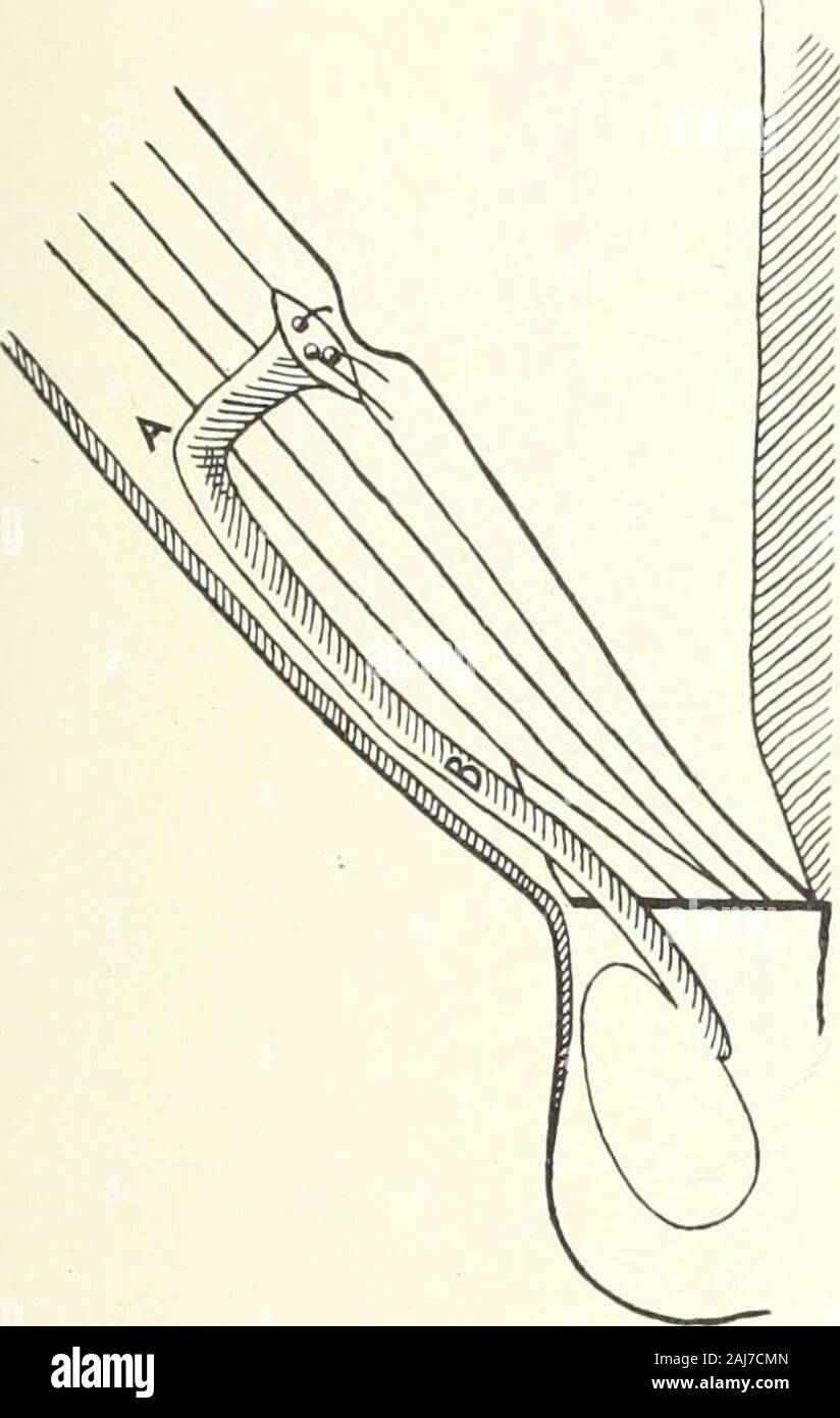 The medical age : a semi-monthly journal of medicine and surgery . c with sac broughtthrough aponeurosis of external oblique muscle). Closing the canal by cicatrization was practised for a short time. Thisbecame known as the operation of McBurney, by whom it was prominentlyadvocated. His form of procedure was to make an incision parallel toPouparts ligament and over the inguinal canal. The sac was freed andligated very high up. The skin edges were fastened by tension sutures to themuscular layers on either side, and the wound was tamponed with iodoformgauze arranged in wedge shape and extendin Stock Photo