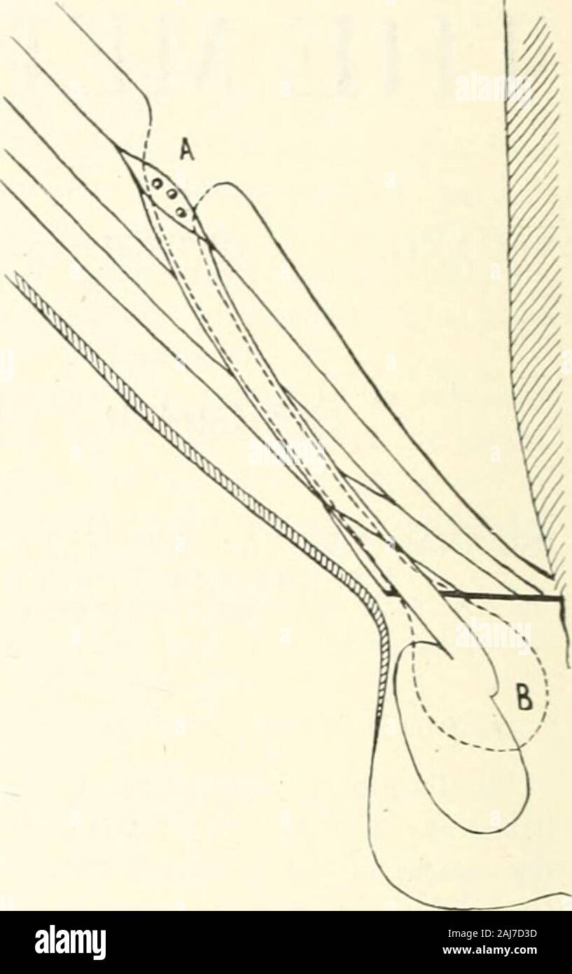 The medical age : a semi-monthly journal of medicine and surgery . Fig. i.—Normal relations. A, skin and super-ficial fascia; B, external oblique muscle; Cand D, internal oblique and transversalismuscles forming conjoined tendon below; I .transversalis fascia; F, peritoneum; G, inter-nal abdominal ring; H, infundibulum; I (darkline), crest and symphysis pubis; J, externalabdominal ring; K, peritoneal cavity; I., rec-tus abdominis muscle; M, scrotum. Fig. 2.—Hernial sac protruding. (Dotted lineshows peritoneum carried down, forming her-nial sac). A, neck of sac entering internalring; B, sac in Stock Photo