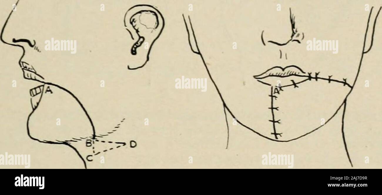 Plastic surgery; its principles and practice . construction of the lower lip with lateral flaps, pediclesbelow (Jdsche).—i and 2. The curved dark lines indicate the incisions through the fullthickness of the cheeks. These are shifted inward and sutured in the midline, A to B. Erichsen excises triangles of normal tissue at the angles, and in themidline below, but when the wounds are closed there is constrictionof the buccal orifice together with a considerable amount of scarring. All of the operations by the French method in which bilateral flaps SURGERY OF THE LIPS 525 are used are designed to Stock Photo