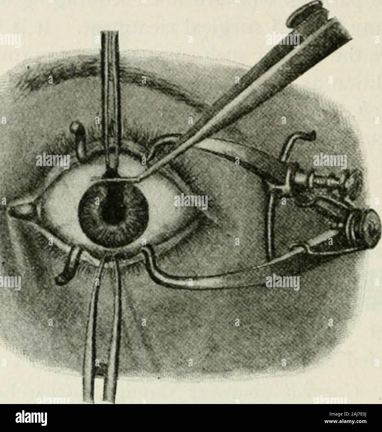 The commoner diseases of the eye : how to detect and how to treat them . s should first be treated and, if possible,cured. If this is neglected, the abundant germswhich these diseases supply are very likely toinfect the corneal wound and lead to muchdreaded complications. 4.. Corneal opacities should be searched for,and if found, the patient should be warned thatthey form a bar to realization of perfect vision. 5. It is very important, in view of their ulti-mate effect upon the eyesight, that the presenceor absence of deep-seated disease of the eyeshould be demonstrated. It would be very, dis- Stock Photo