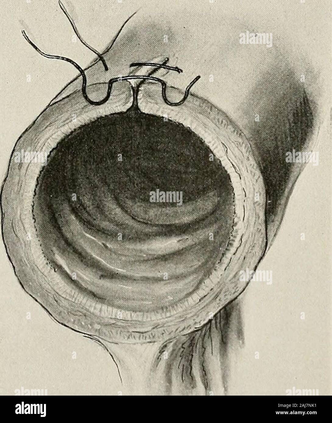 Surgical treatment; a practical treatise on the therapy of surgical diseases for the use of practitioners and students of surgery . Fig. 1286.—Simple Right-angle Infolding Suture of Lembert, Combined with Un-derlying Penetrating Suture, Diagrammatic. The seromuscular mattress stitch represents two stitches with one tie (Fig.1287).. Fig. 1287.—Seromuscular Mattress Stitch. The right-angle mattress stitch (Halsted) (Fig. 1288) represents onetie for every two simple right-angle stitches (Lembert). This is modified(Gould) by reversing the direction of introduction on one side (Fig. 1289). 634 SURG Stock Photo