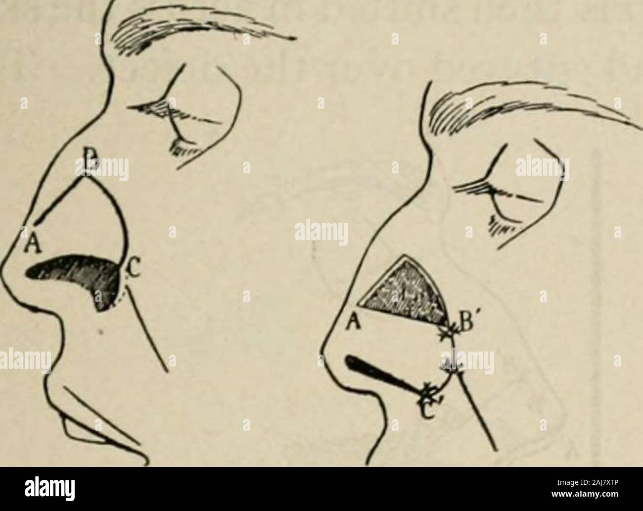 Plastic Surgery Its Principles And Practice The Fullthickness Of The Nose Including The Rim Of The Defect Have Been Shifteddown To Form The Margin Of The Ala And The Defect Above