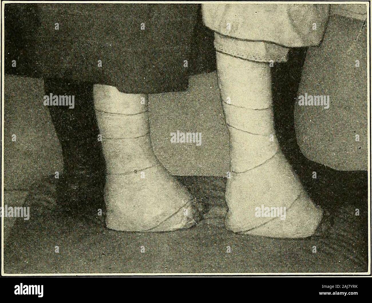 Calcaneovalgus hires stock photography and images Alamy