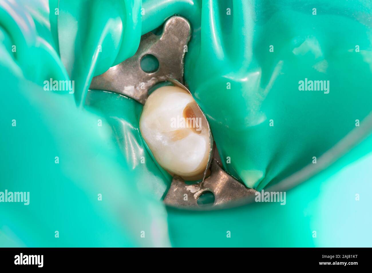 Dental caries. Filling with dental composite photopolymer material