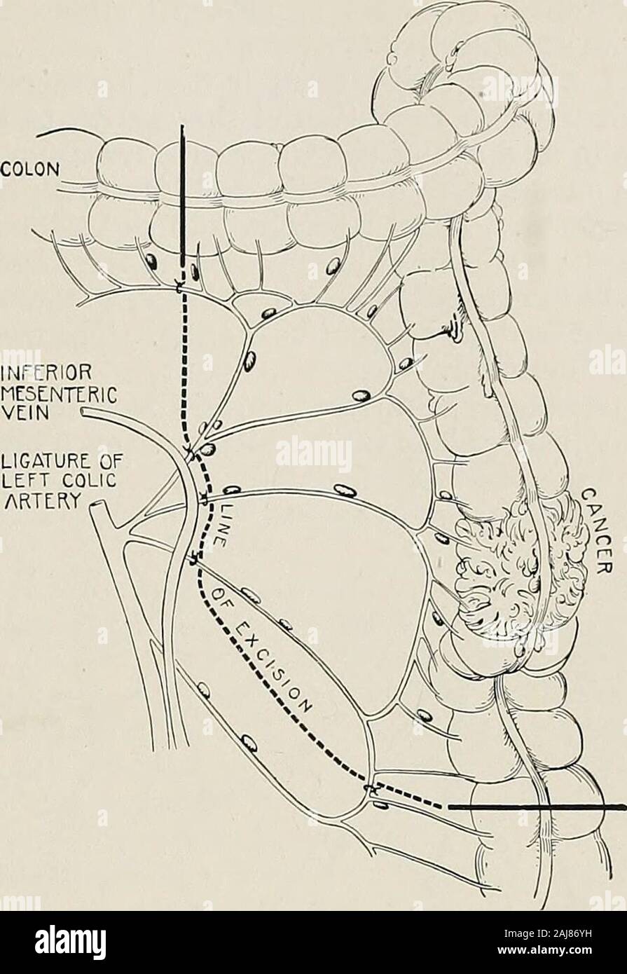 Splenic flexure hi-res stock photography and images - Alamy