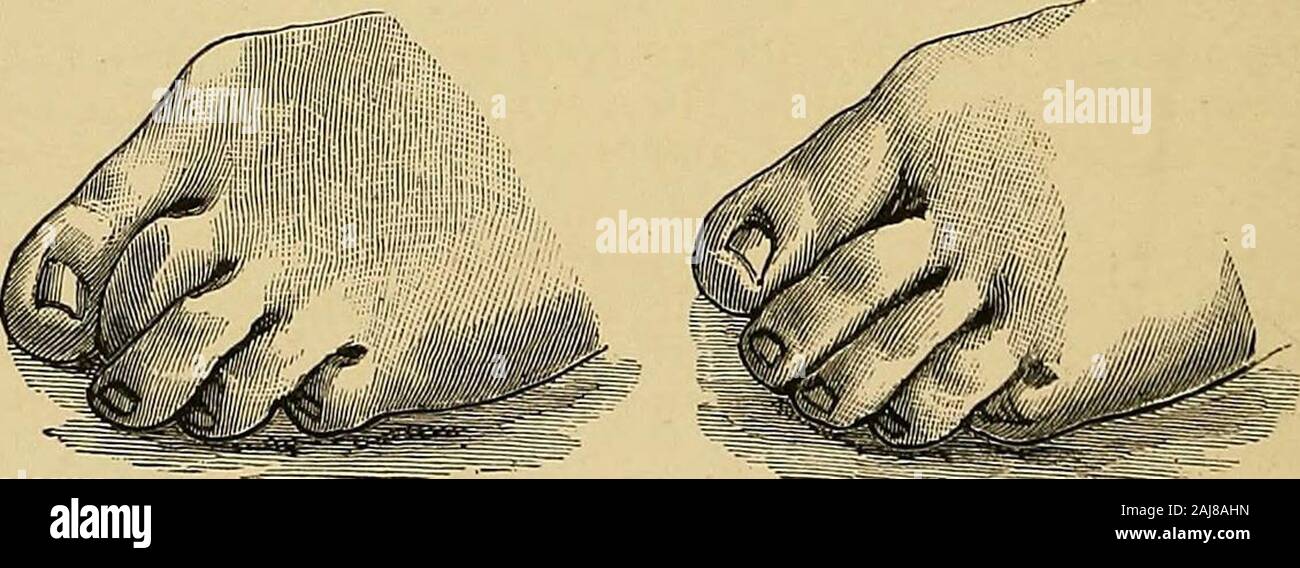 Toe Contraction On contractions of the fingers (Dupuytren's and congenital contractions ...