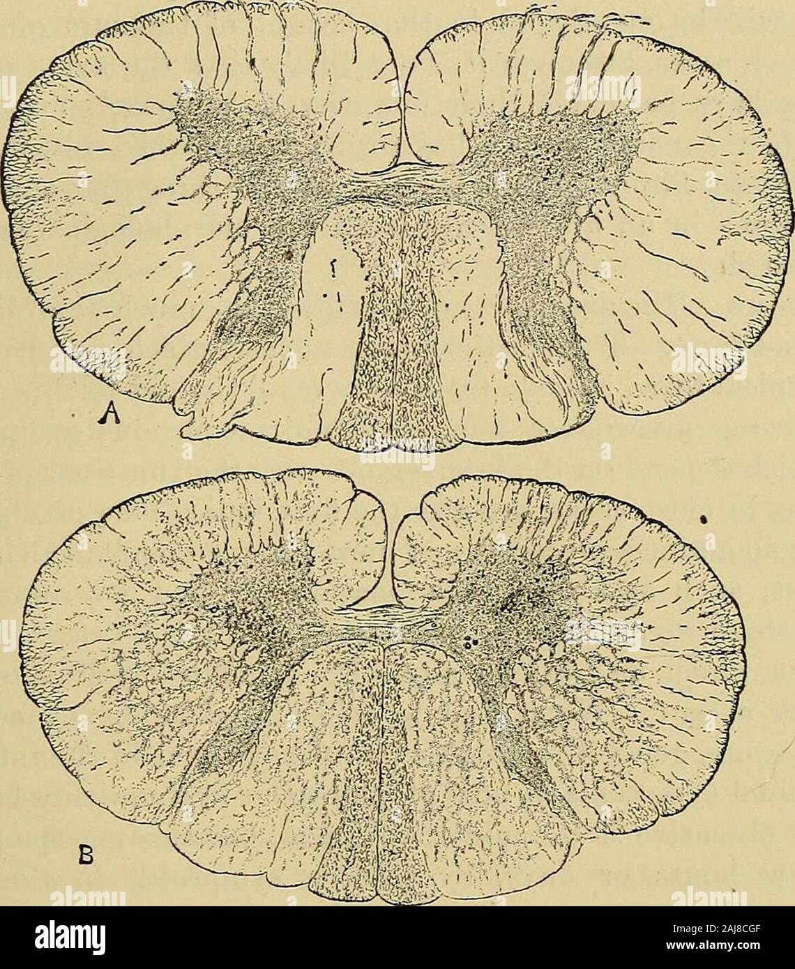 A manual of diseases of the nervous system . fibres are smaller than anymet with in the normal cord. The appearance is as if there hadbeen an irregular ascending myelitis, which had extended up thecord as high as between the seventh and eighth cervical segments,and from the lower extremity of the normal fibres there had occurreda growth of new fibres such as effects the regeneration of nerves.*We seem to have here an actual process of renewal of fibres that hadbeen destroyed by such inflammation as has caused the empty spacesin the vicinity. If this is a correct interpretation of the appearanc Stock Photo