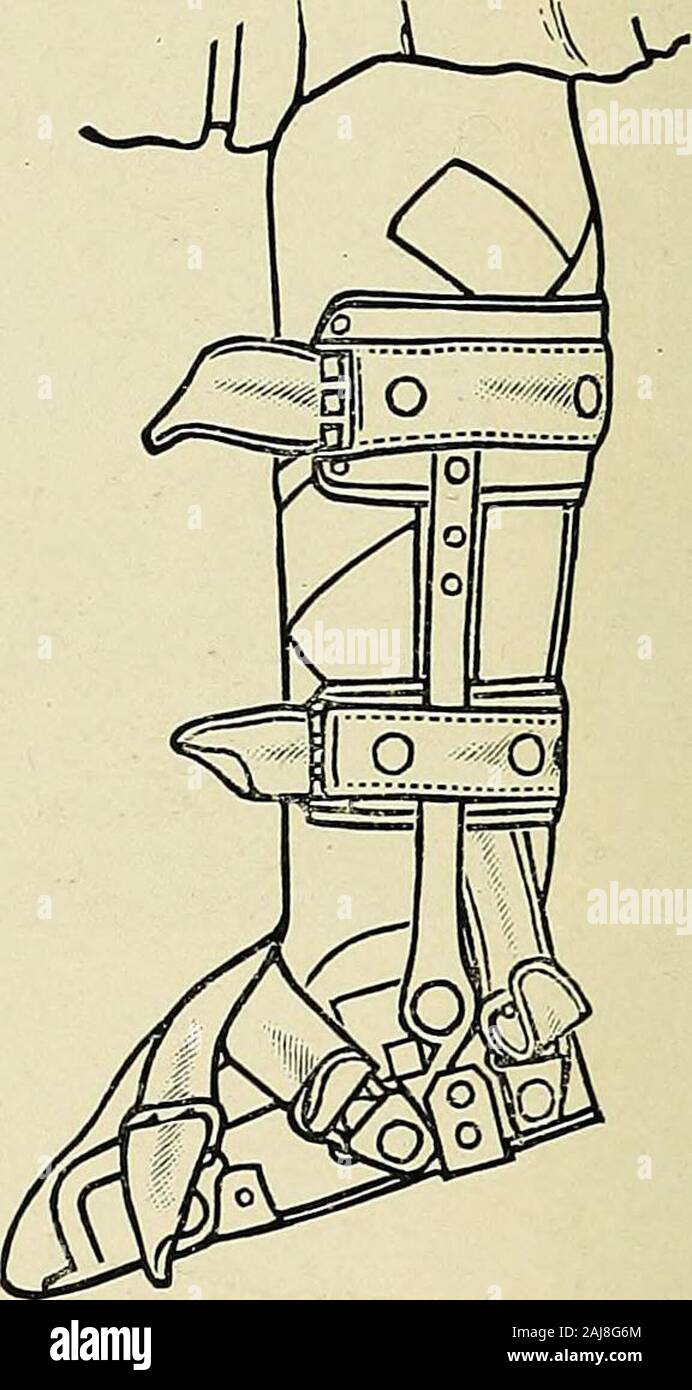 A treatise on orthopedic surgery . The Taylor clubfoot biace, showing