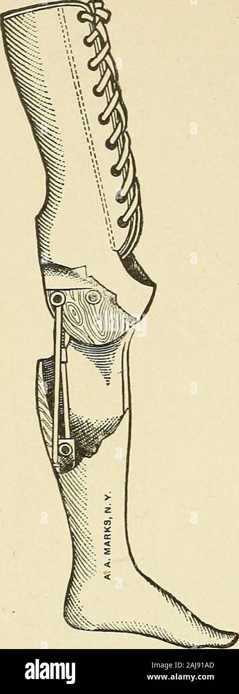 Preparatory and after treatment in operative cases . 624 ARTIFICIAL LIMBS. Fig. 411.:— Appliance forkxee-bearixg stumps. the bolt is passing through the metal earwhich is riveted to the lower leg, the headsinks into its bed and the threaded endscrews into the ear riveted to the oppo-site side. Fig. 410 shows the mechanismof the apparatus; a is the bolt. The setscrew b, placed into the flanged end, pre-vents the bolt from moving and workingout; c is the check cord screw; d thecheck cord; g the spring piston; h thespiral spring; i the cylinder. The rela-tions and functions of these parts can be Stock Photo