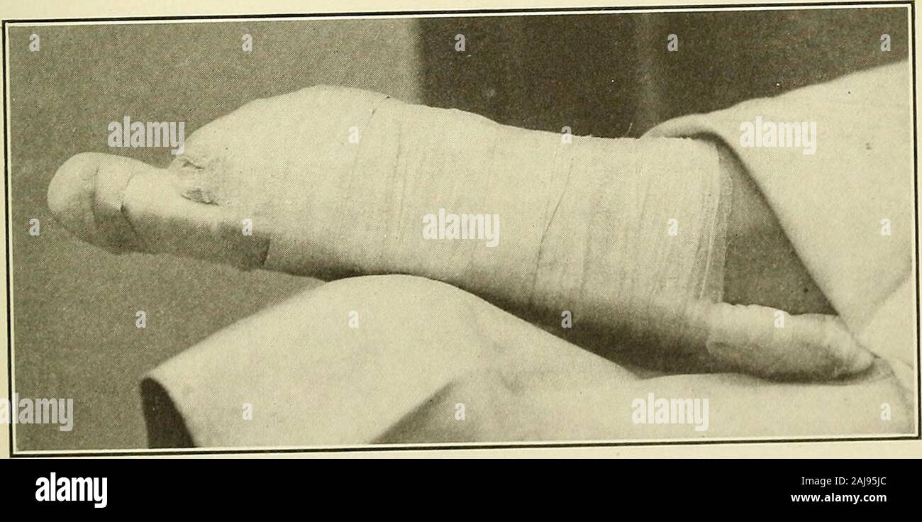 Preparatory and after treatment in operative cases . Fig. 388.—Amputation Wound Closed with Interrupted Sutures and TubeDrainage Introduced. repeated at intervals of forty-eight hours until the infection sub-sides, at which time horsehair or silk-worm gut drainage (page. Fig 389.—Amputation Wound Dressed, Stump Immobilized on Posterior PaddedSplint and Thigh Extended to Relax Muscles. 193) is used, until the secretion of inflammatory products ceasesto discharge. If the infection is severe, it is best to remove 610 OPERATIOXS ON THE EXTREMITIES entirely the sutures and treat the case as is desc Stock Photo